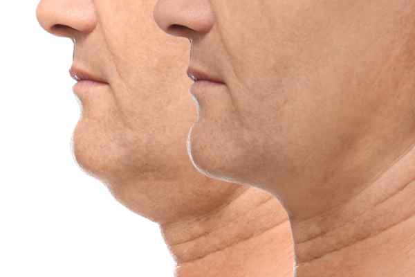 HIFU - Breakthrough in Anti - ageing 2 hifu results Chelmsford