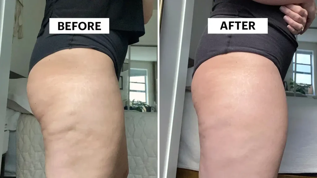 Sculpting Your Bum: Can Toning Exercises Really Reduce Cellulite? 1 Do Toning Exercise Chelmsford Really Tackle Cellulite?