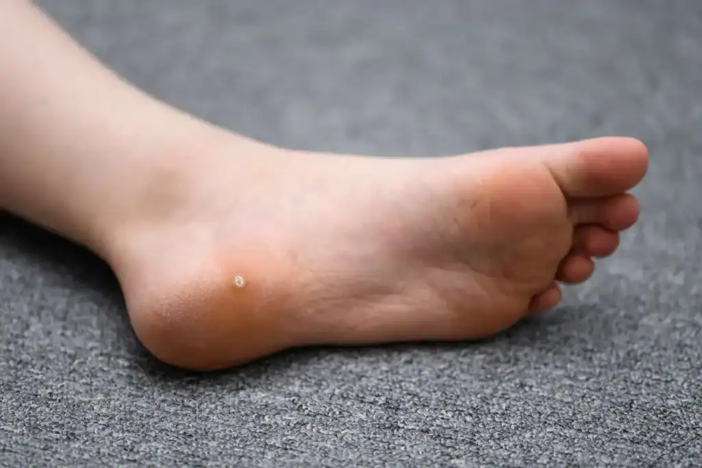 Cryotherapy For Warts And Also Verrucas 2 Image of verruca on the bottom of the foot that able to be treated with Cryotherapy Chelmsford