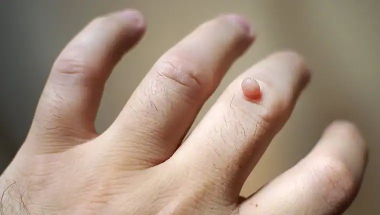 Cryotherapy For Warts And Also Verrucas 1 Image of blemish that Cryotherapy Chelmsford can remove with Lipo 360.