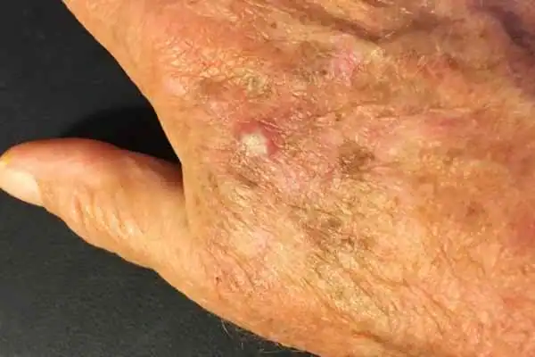 Image of Actinic keratoses Chelmsford on a person hand