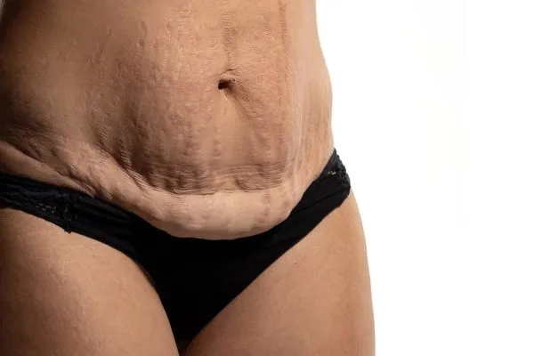 The Science of Skin Tightening 1 The science behind skin tightening Chelmsford picture of a woman's sagging skin on the stomach